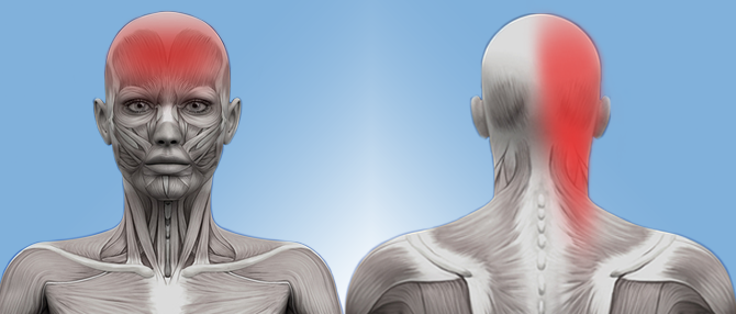 Glavobolja zbog temporomandibularnog poremećaja (poremećaja zgloba donje vilice) | MediHelp