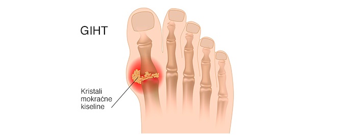 artrita urica
