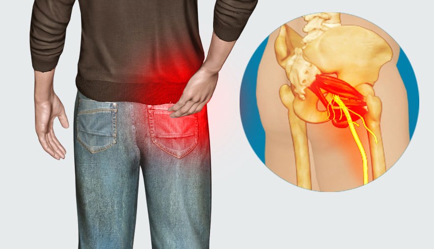 10 simptoma bolova u bokovima - O Zdravlju - 